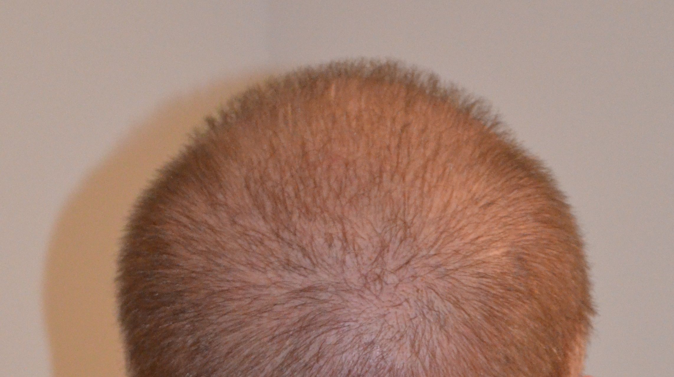 Trico-Pigmentierung gegeven Haarverlust